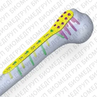 Компрессионная костная пластина плечевая кость  Cytronics