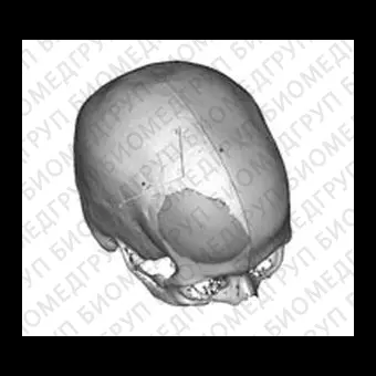 Черепной имплантат на заказ evoShape