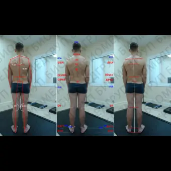 Система оценки осанки 3D B.A.K. Body Analysis Kapture