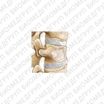 Устройство PCD для чрескожной вертебропластики 11 G, 4 шт. в уп.