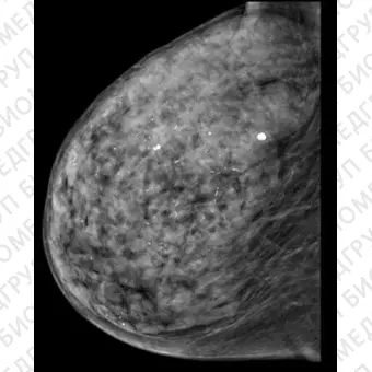 Senographe Pristina Полноформатная маммография без боли