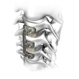 Шейная костная пластина для артродеза VERTEVIEW